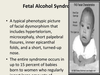 Fetal Alcohol Syndrome

• A typical phenotypic picture
  of facial dysmorphism that
  includes hypertelorism,
  microcephaly, short palpebral
  fissures, inner epicanthal
  folds, and a short, turned-up
  nose.
• The entire syndrome occurs in
  up to 15 percent of babies
  born to women who regularly
 