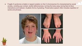 ● Fragile X syndrome a triplet or repeat mutation on the X chromosome-It is characterized by social
anxiety, avoiding eye contact, tactile defensiveness, turning the body away during face-to-face
interactions and stylized, ritualistic forms of greeting. Preservative speech often includes repetition of
words and phrases.
 