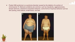 ● Prader-Willi syndrome is a syndrome disorder caused by the deletion of a portion of
chromosome 15. Behavior problems are common, such as impulsivity, aggressiveness,
temper tantrums, obsessive-compulsive behavior, some forms of injurious behavior such as
skin picking, short stature, small hands, and feet.
 