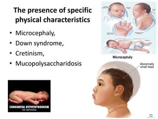 The presence of specific
physical characteristics
• Microcephaly,
• Down syndrome,
• Cretinism,
• Mucopolysaccharidosis
 