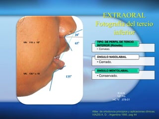 Mentoplastía.pdf