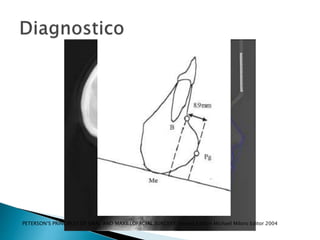 PETERSON‘S PRINCIPLES OF ORAL AND MAXILLOFACIAL SURGERY Second Edition Michael Miloro Editor 2004
 