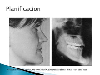 PETERSON‘S PRINCIPLES OF ORAL AND MAXILLOFACIAL SURGERY Second Edition Michael Miloro Editor 2004
 