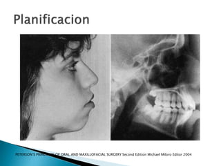 PETERSON‘S PRINCIPLES OF ORAL AND MAXILLOFACIAL SURGERY Second Edition Michael Miloro Editor 2004
 