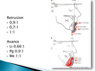 Retrusion
 0,9:1
 0,7:1
 1:1
Avance
 Li 0.66:1
 Pg 0.9:1
 Me 1:1
 