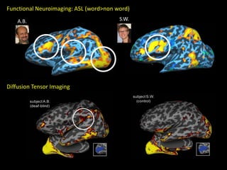Neuroplasticity Following Sensory Loss