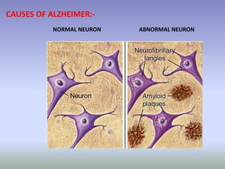 CAUSES OF ALZHEIMER:-
NORMAL NEURON ABNORMAL NEURON
 