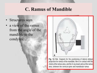 Rounded Ramus landmarks and interpretation in extraoral radiography | PPTX