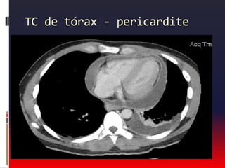 Principais causas de dor torácica                                  Causas pulmonares:Pneumotórax.Embolia pulmonar.Pleurite.Hipertensão pulmonar.Neoplasia.