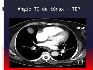 Dor de origem pulmonarPneumotórax  espontâneo:Inicio subito de dispnéia dor pleuritica, unilateral, em dorso e ombosEvolução:insuficiência respiratória choque circulatório.Exame físico: dispnéiataquipnéia ausência de ruídos no hemotórax afetado.