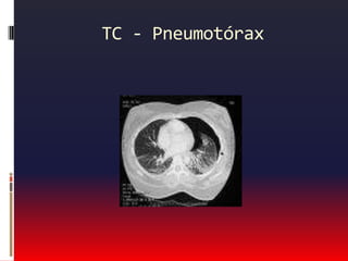 Dor de origem pulmonarHipertensão pulmonar:Dor torácica subesternalExacerbada pelo esforçoAssociada a dispnéia
