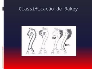 CLASSIFICAÇÃO DE STANFORD