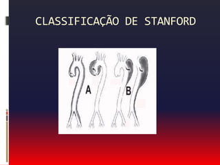 DISSECÇÃO AÓRTICA