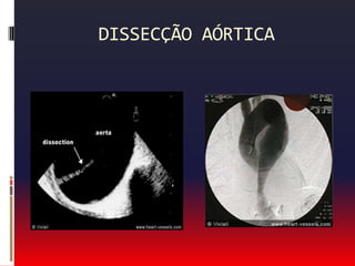 TC – dissecção de aorta