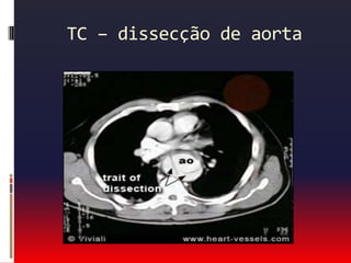 Principais causas de dor torácica                     Causas  Gastroesofágicas:Refluxo gastroesofágico.Espasmo esofágico.Úlcera de esôfago ou péptica.Ruptura de esôfago.
