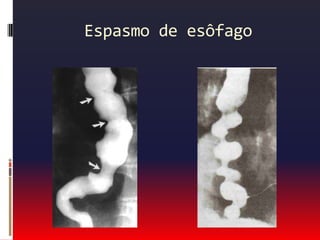 Dor esofágica ou gastroduodenalÚlcera péptica:Queimação  epigástrica ou subesternal prolongada.Geralmente ocorre após refeição e melhora com anti-ácidos.