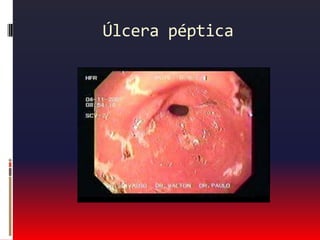 Dor esofágica ou gastroduodenalRuptura esofágica:Pode ocorrer por vômitos intensos ou trauma.Dor excruciante, retroesternal e em andar superior do abdome, com dor pleurítica esquerda.Alta mortalidade.Pneumomediastino e enfisema subcutâneo.