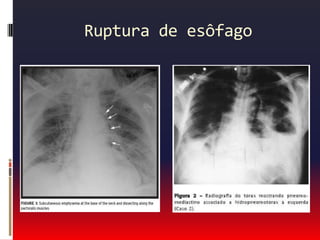 Principais causas de dor torácica                Causas psiquiátricas:Transtorno do pânico.Transtornos de ansiedade.Depressão.Somatização.