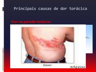Principais causas de dor torácicaDor na parede torácica:Lesões em costelas  (trauma, metástases).Costocondrite.Fibromialgia.Dores musculares.Síndromes radiculares.Nervos sensitivos (herpes zoster).