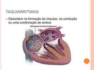 TAQUIARRITMIASDesordem na formação do impulso, na condução  ou uma combinação de ambos