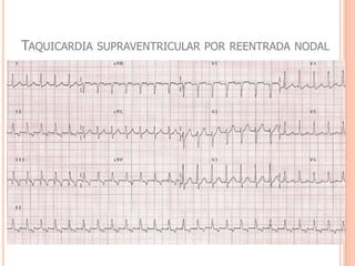TAQUICARDIA SINUSALAparece Ritmo sinusal com FC entre 100 e 160bpmEtiologia: hipovolemia, ansiedade, hipertireoidismo, infecções, hipoxia, febre, álcool, cafeína, tabaco...ECG:Sinusalonda Pcomplexo QRS estreitosCorrigir a causa base resolve a arritmia...Sintomaticos