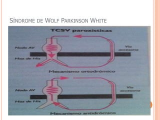 FA- ClínicaClinica varia desde assintomática até instabilidade hemodinamica.Resposta Fa dependente:Resposta ventricular excessiva:Hipotensão, dispnéia por insuficiência cardiaca ou angina.Pausa pós FA paroxistica:SincopeTromboembolismo sistêmicoDebut AVC embolico10-40% casos.Diminuir a contração auricular de enchimento ventricular: diminuir débito cardiacoFC elevada mantida: miocardipatia com disfunção VE