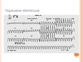 FA- ClinicaFA          Ritmo ventricular e lento                                 BAVTResposta ventricular             Regular e Rápida                                                           TV