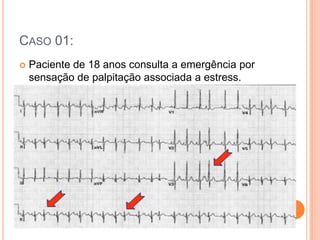 Caso 01:Paciente de 18 anos consulta a emergência por sensação de palpitação associada a estress.O ECG: