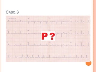 Pausa compensatória incompleta. 