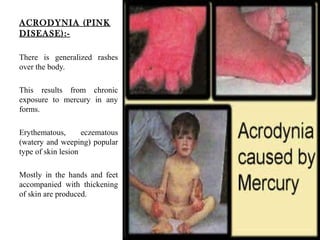 Merc Rash Mercury Poisoning | PPT
