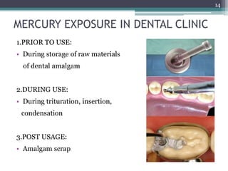 MERCURY EXPOSURE IN DENTAL CLINIC
1.PRIOR TO USE:
• During storage of raw materials
of dental amalgam
2.DURING USE:
• During trituration, insertion,
condensation
3.POST USAGE:
• Amalgam scrap
14
 