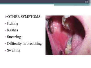 OTHER SYMPTOMS:
• Itching
• Rashes
• Sneezing
• Difficulty in breathing
• Swelling
20
 
