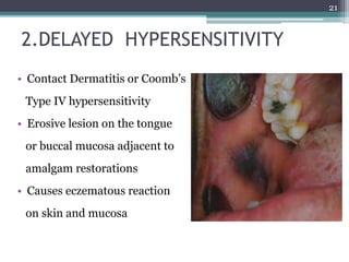 2.DELAYED HYPERSENSITIVITY
• Contact Dermatitis or Coomb’s
Type IV hypersensitivity
• Erosive lesion on the tongue
or buccal mucosa adjacent to
amalgam restorations
• Causes eczematous reaction
on skin and mucosa
21
 