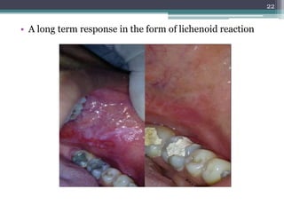 • A long term response in the form of lichenoid reaction
22
 