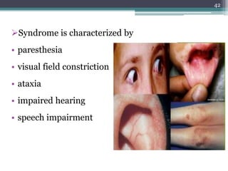 Syndrome is characterized by
• paresthesia
• visual field constriction
• ataxia
• impaired hearing
• speech impairment
42
 