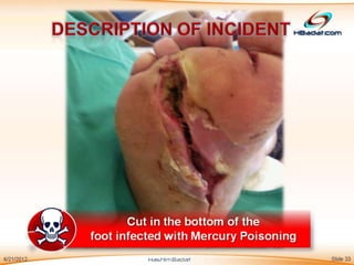 Mercury Hazards & Poisoning