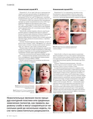 26  ОБЛИК | Январь 2015
ГЛАВНОЕ
Клинический случай № 4
Пациентка В., 67 лет предъявляла жалобы на отек,
болезненность при пальпации в области лица и шеи
и жжение, усиливающееся после нанесения бепантен
мази после процедуры фракционной лазерной шлифовки.
Клинический случай № 3
Пациентка Х., 52 лет через день после процедуры кон‑
турной пластики красной каймы губ препаратом на ос‑
нове стабилизированной гиалуроновой кислоты, кон‑
центрацией 25,5 мг / мл и pH 7,0 обратилась с жалобами
на выраженный отек, боль, чувство жжения в области губ.
Из анамнеза: в 2010 году пациентке был инъецирован
препарат на основе гиалуроновой кислоты; в 2011 году —
операция блефаропластика верхнего века; в июле
2012 года — процедура ботулинотерапии. Из перенесен‑
ных заболеваний в 2010 г. в начале августа был впервые
герпес красной каймы губ с усиленным отеком. Повтор‑
но — 19.03.2014 года.
Status localis: кожные покровы в области лица бледно-
розовой окраски, в периоральной области справа не‑
сколько (4) папулезных элементов. В области левой щеки,
ближе к верхнему веку ограниченная отечность[Рис. 10]
.
Красная кайма верхней и нижней губы отечные, выражены
серозные корки, множество мелких везикул, с серозным
отделяемым[Рис. 11]
.
Лечение. Назначен фамцикловир «Фамвир» по 0,25 г 2
раза в сутки в течение 7 дней; «Эргоферон» по 1 таблетке
2 раза в день в течение 1 месяца; калий, магний «Допель‑
герц» по 1 таблетке 1 раз в день в течение месяца.
Фамцикловир из группы противовирусных средств (ати‑
пичных нуклеозидов), которые встраиваются в ДНК виру‑
са герпеса и нарушают его последующую репродукцию. Это
этиотропное лечение герпес вирусной инфекции[7]
.
В качестве патогенетической терапии выбран эргофе‑
рон — гомеопатический препарат (низкодозовые анти‑
тела к интерферону), обеспечивающий нормализацию
продукции клетками ИФНα и ИНФγ.
Калий и магний нужны для улучшения метаболизма
клеток, в том числе и нервных.
Фото 8. Пациентка Х., 52 года, до процедуры
контурной пластики губ филлером на основе
гиалуроновой кислоты
Фото 9. Пациентка Х., 52 года, на следующий день
после процедуры с герпесной инфекцией красной
каймы губ
Нежелательные явления после проце‑
дур контурной пластики или срединных
химических пилингов, как правило, вы‑
ражены слабо и могут сохраняться от не‑
скольких дней до нескольких недель, по‑
сле чего самостоятельно разрешаются.
Status localis: в области лица имеются единичные
эрозии размером от 0,5 до 1,0 см красно-коричневого
цвета, в области шеи на фоне отечной кожи наблюда‑
ется эритематозное пятно размером до 15 см, с неров‑
ными (фестончатыми) краями, болезненное при паль‑
пации [Рис. 8]
.
Лечение. Пациентке рекомендовано: «Кестин»
по 10 мг 2 раза в сутки в течение 7 дней; «Адвантан»
эмульсия 2 раза в сутки в течение 5 дней.
Аллергическая реакция развилась в первые сутки
после инвазивной процедуры и характеризуется гипе‑
ремией, отеком, обусловленным реагинами (IgE) и де‑
грануляцией тучных клеток с выходом гистамина [4, 6]
,
последний воздействовал на Н1-рецепторы и вызвал
отек сосочкового слоя дермы. Поэтому основой общей
терапии является назначение антигистаминных препа‑
ратов II поколения, которые конкурентно связывают
Н1-рецепторы. Эбастин (препарат «Кестин») эффек‑
тивен в этой ситуации. Местно — топический глюко‑
кортикостероид метилпреднизолона ацепонат 0,1 %
эмульсия — в соответствии с показаниями (острые
воспалительные заболевания кожи, аллергический
дерматит, сильный солнечный ожог). Этот препарат
в форме эмульсии обеспечивает быстрый противовос‑
палительный, антиэкссудативный эффект; уменьшает
инфильтрацию тканей клетками.
Фото 10. Пациентка В., 67 лет. Появление нежелательных
явлений в первые сутки после процедуры фракционной
лазерной шлифовки
Фото 11. Пациентка В., 67 лет, после терапии
10a
10b
10c
11a 11b 11c
9a8
9b
 