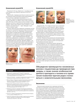 Январь 2015 | Облик  27
Клинический случай № 5
Пациентка Р., 64 года, обратилась с жалобами на чув‑
ство жжения и зуд в области лица после 15 % ТСА-
пилинга.
Status localis: в периоральной области имеется несколь‑
ко элементов, представленных везикулами размером
от 0,2 до 0,5 см с серозным отделяемым[Фото 12]
.
Лечение. Пациентке были рекомендованы валаци‑
кловир («Валтрекс») по 500 мг 2 раза в день в течение 5
дней; «Кестин» по 10 мг 2 раза в сутки в течение 5 дней;
наружно, на область герпетических высыпаний, гель «Ве‑
румерц» 2 раза в день тонким слоем в течение 3 – 5 дней;
в щечно-скуловой области — крем «Тридерм» 2 раза
в день в течение 3 дней.
Лечение герпетического дерматита этиотропно систем‑
но сводится к назначению валацикловира (атипический
нуклеозид) и местно гель «Верумерц» (тромантадина
гидрохлорид), который является противовирусным
препаратом для наружного применения. Для лечения
контактного аллергического дерматита применяется
«Тридерм» — крем (комбинированный препарат — бе‑
таметазона дипропионат, клотримазол и гентамицин),
он оказывает противоаллергическое, антигрибковое
и антибактериальное действие. Препарат выбран с уче‑
том известного иммуносупрессивного действия вируса
герпеса, что может явиться условием присоединения
к контактному аллергическому дерматиту грибковой
и бактериальной инфекции.
Клинический случай № 6
Литература
1.	Юцковская Я. А., Дворянинова И. Е., Таран М. Г., Лешунов Е. В.,
Бирко О. Н. Нежелательные явления в инъекционной косметологии //
Les Nouvelles Esthetiques. 2013, № 4 (80). С. 2 – 6.
2.	Лапатина Н. Белотеро — расширение возможностей контурной пластики //
Инъекционные методы в косметологии. 2009, № 10. С. 82 – 83.
3.	Фант Д., Павичич Т. Применение дермальных филлеров в эстетической
медицине: побочные эффекты и методы их коррекции. Обзор //
Пластическая хирургия и косметология. 2014, № 2. С. 3 – 25.
4.	Юцковская Я. А., Дворянинова И. Е., Таран М. Г., Лешунов Е. В.,
Бирко О. Н. Нежелательные явления после применения дермальных
филлеров. Случаи из практики клинициста-косметолога //
Эстетическая медицина. 2013, № 2 (XII). С. 3 – 8.
5.	Карпова Е. И., Адамян А. А., Данищук О. И. Динамика ультразвуковых
и гистоморфологических критериев в оценке эффективности контурной
инъекционной пластики лица // Клиническая дерматология и венерология.
2013, № 1. С. 107 – 114.
6.	Козлов С. Н., Зузова А. П., Белькова Ю. А. Глюкокортикоидные препараты.
3‑е изд. Смоленск: МАКМАХ, 2014. 112 с.
7.	Халдин А. А., Халдина М. В. Простой герпес в дерматокосметологической
практике. Проблемы и пути решения // Пластическая хирургия
и косметология. 2010, № 3. С. 464 – 468.
Пациентка Щ., 37 лет. Через 10 минут после нанесения
15 % ТСА-пилинга до «асбестовидного» фроста произо‑
шло резкое побеление кожи в местах нанесения препара‑
та и появление отека в периорбитальной области[Фото 13]
.
Status localis: кожные покровы в области лица бледно-­
розовой окраски с множественными мелкими пигмент‑
ными пятнами желто-коричневого цвета; имеются очаги
побеления кожи в местах нанесения ТСА-пилинга и отек
в периорбитальной области.
Лечение. Пациентке была проведена внутримышечная
инъекция дексаметазона 16 мг, а также назначен «Эриус»
по 5 мг 1 раз в сутки в течение 10 дней и нестероидные
противовоспалительные средства.
Целесообразность назначения данных препаратов
была обусловлена тем, что у пациентки развилась острая
воспалительная реакция на химическое повреждение
и аллергическая реакция на трихлоруксусную кислоту
по реагиновому типу (с участием IgE и дегрануляцией
тучных клеток). Применение глюкокортикостероида
дексаметазона с минералокортикоидной активностью
оказывает быстрое противоаллергическое, противовоспа‑
лительное действие, повышает чувствительность бета-
адренорецепторов к эндогенным катехоламинам.
Применение антигистаминных препаратов II поколе‑
ния оказывает действие на Н1-рецепторы и не дает реа‑
лизовывать эффекты гистамина. Нестероидные противо‑
воспалительные препараты оказывают анальгезирующее
действие.
Фото 13.
Пациентка Щ., 37 лет.
Во время проведения
процедуры 15 % ТСА-
пилинга
Фото 12. Пациентка Р., 64 года. На второй день после процедуры
15% ТСА-пилинга
12a 12b
13a 13b 13c
Заключение
Нежелательные явления после процедур контурной
пластики или срединных химических пилингов, как пра‑
вило, выражены слабо и могут сохраняться от нескольких
дней до нескольких недель. Применение своевременной
этиотропной и патогенетической терапии обеспечивают
их эффективную коррекцию. Обсуждение преимуществ
и возможных рисков с пациентами до проведения про‑
цедуры, а также знание особенностей данного препарата
и техники его применения позволяют врачам редко стал‑
киваться с нежелательными явлениями.
Обсуждение преимуществ и возможных
рисков с пациентами до проведения про‑
цедуры, а также знание особенностей
данного препарата и техники его приме‑
нения позволяют врачам редко сталки‑
ваться с нежелательными явлениями.
 