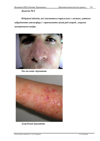 Виставка ППД «Освіта Черкащини» Проектні технології на уроках…
Золотоніська гімназія ім. С.Д. Скляренка І.А. Кононець
141
Додаток № 6
Побутові відходи, які спалюються паралельно з листям, суттєво
забруднюють атмосферу і спричиняють цілий ряд хвороб, .зокрема
захворювання шкіри.
Так виглядає дерматит.
Алергічний дерматит.
 