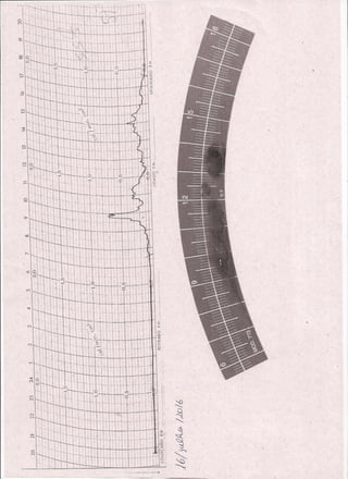 Tiras do Heliógrafo e Actinógrafo e exemplos com comparações