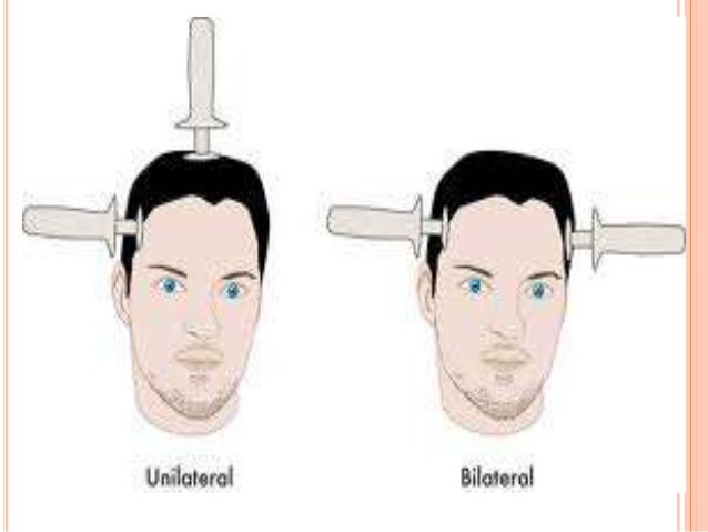 4 Ect Electrode Options Which Is Best For Your Patient Mdedge