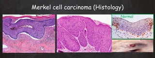 Merkel cell carcinoma (Histology)
Normal
 