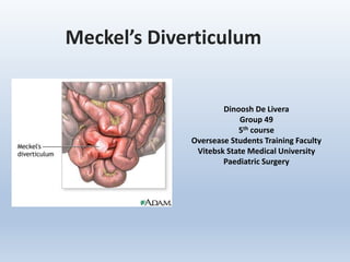 Meckel’s Diverticulum
Dinoosh De Livera
Group 49
5th course
Oversease Students Training Faculty
Vitebsk State Medical University
Paediatric Surgery
 