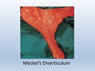 Meckel’s Diverticulum
 
