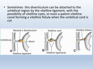 • Sometimes this diverticulum can be attached to the
umbilical region by the vitelline ligament, with the
possibility of vitelline cysts, or even a patent vitelline
canal forming a vitelline fistula when the umbilical cord is
cut
 