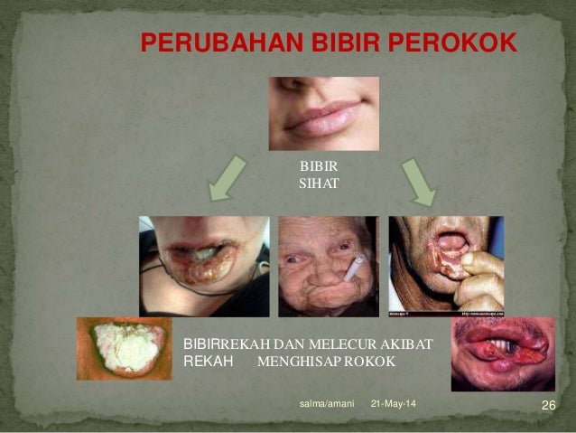 Ubat Gigi Rokok - Perokok 0 Ubat Gigi Rokok - Perokok 0