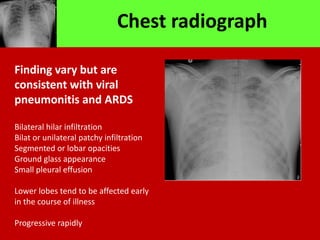 Chest radiograph
Finding vary but are
consistent with viral
pneumonitis and ARDS
Bilateral hilar infiltration
Bilat or unilateral patchy infiltration
Segmented or lobar opacities
Ground glass appearance
Small pleural effusion
Lower lobes tend to be affected early
in the course of illness
Progressive rapidly
 