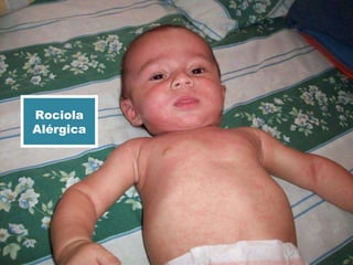 Rociola Alérgica 
