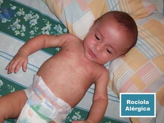 Rociola Alérgica 