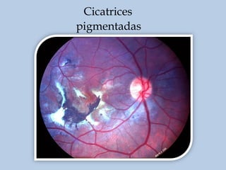 Cicatrices
pigmentadas

 